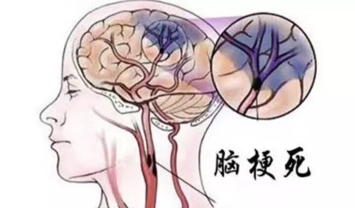 脑梗容易复发吗?复发前都有哪些征兆?