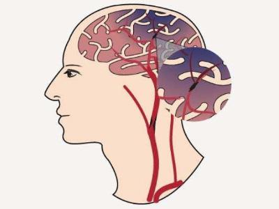 择思达斯_脑血栓形成的因素有哪些?